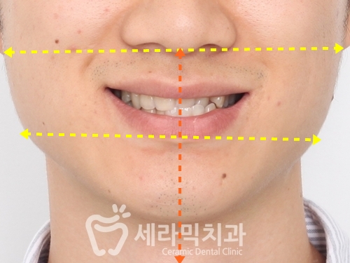 세라믹치과 치아교정전후 : 앞니반대교합+치열불규칙 관련 이미지 6