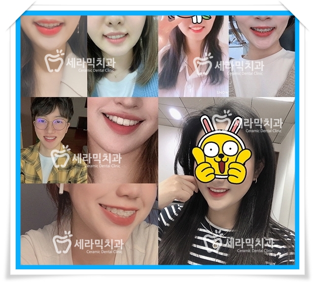 돌출입과 과개교합, 중심선 불일치, 치열불규칙 치아교정전후사진 관련 이미지 9