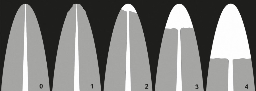 세라믹교정 가격 4대부작용 관련 이미지 7