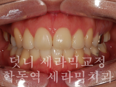 덧니교정 잘하는 학동역 교정치과, 세라믹치과 관련 이미지 8