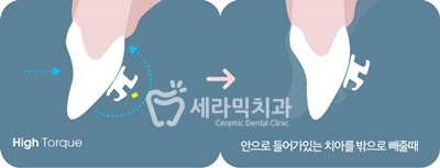 토끼이빨 돌출입 치아교정 전후 표정변화! 관련 이미지 12