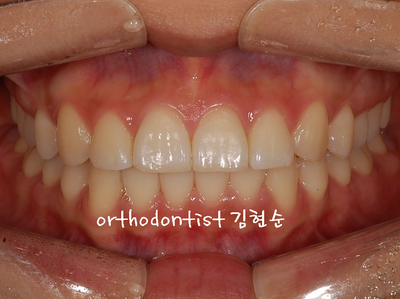 돌출 교정 (비발치 교정/비대칭) 관련 이미지 26