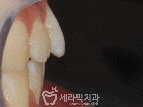 돌출입 앞니부분교정 치아교정전후 더 환해진 미소! 관련 이미지 2