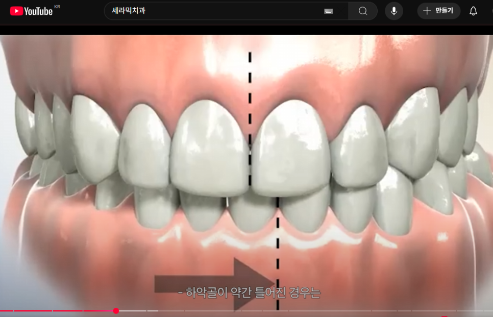 좌우 얼굴비대칭 원인, 문제점, 치료방법 - 비수술 치아교정 관련 이미지 2