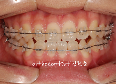 반대 교합 관련 이미지 15