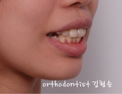 돌출입 발치교정, 미니스크류를 통한 6가지 변화 관련 이미지 3