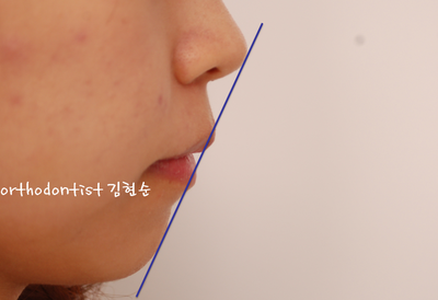 강남 돌출 관련 이미지 34