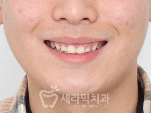 과개교합, 거미스마일, 치아 벌어짐까지 한번에! 치아교정전후 살펴보기 관련 이미지 7