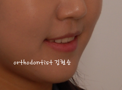 치열 교정(치열 불규칙) 관련 이미지 31
