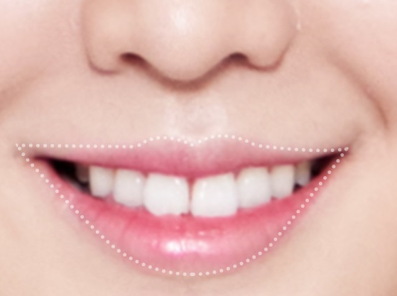 세라믹치과 돌출입교정 투명교정기로 ~ 관련 이미지 11