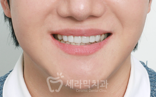 강남라미네이트치과 세라네이트 전후 사례 - 달라진 스마일라인 관련 이미지 4