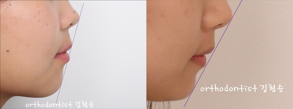 학동역 치아교정, 돌출입 세라믹교정 관련 이미지 3
