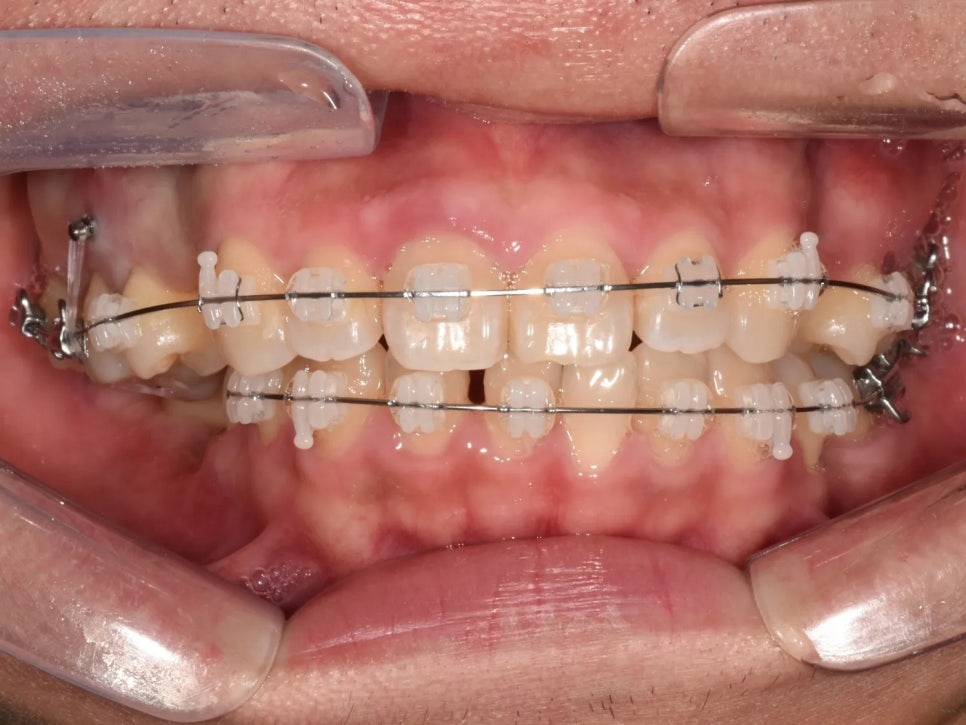 돌출입 교정 전후, 그런데 과개교합까지 있으셨던 환자분 관련 이미지 12