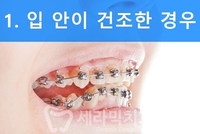 치아교정을 하면 입 냄새가 많이 나요? 관련 이미지 2