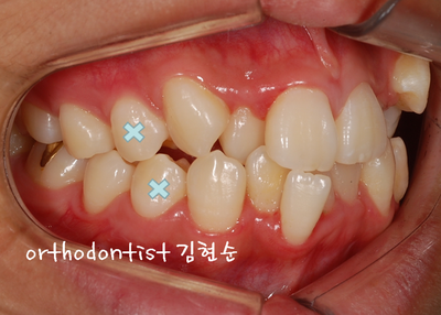 강남 덧니 관련 이미지 12