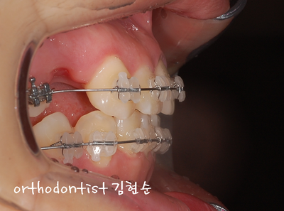 강남 덧니, 돌출 관련 이미지 19