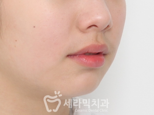 돌출입교정, 심미성과 치아 건강을 동시에 해결! 관련 이미지 9