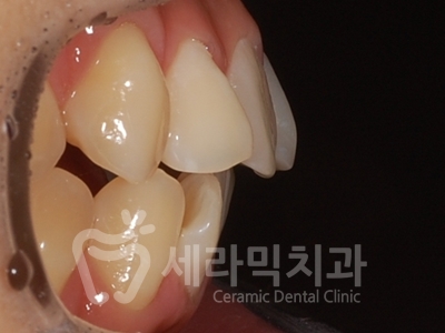 돌출입 덧니 비대칭 치아교정 전후 인상변화! 관련 이미지 11