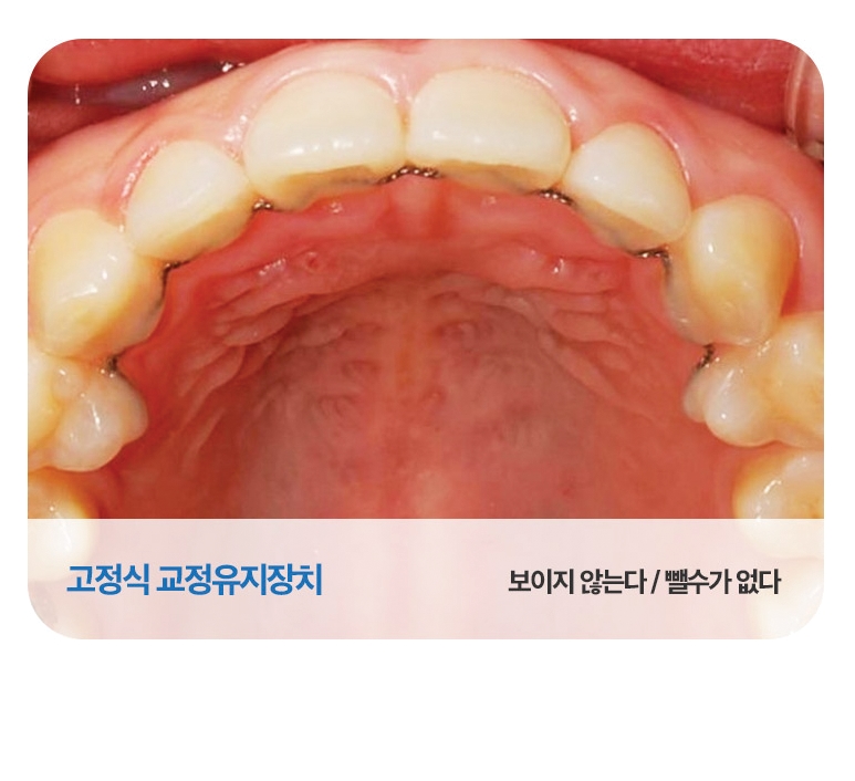 치아교정 유지장치로 부작용 예방을! 관련 이미지 3