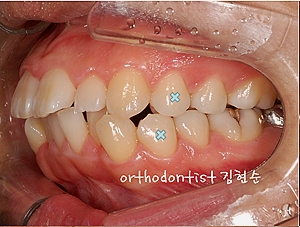 강남 돌출입 교정 관련 이미지 27