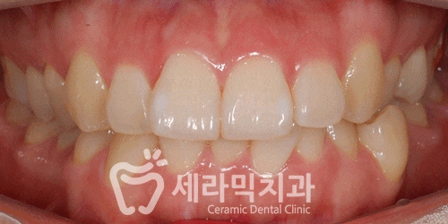돌출입과 과개교합, 중심선 불일치, 치열불규칙 치아교정전후사진 관련 이미지 6