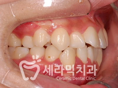 토끼이빨, 틀어진 치아배열 세라믹교정 전후사진 관련 이미지 8
