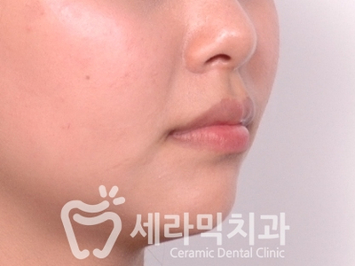 토끼이빨, 틀어진 치아배열 세라믹교정 전후사진 관련 이미지 6