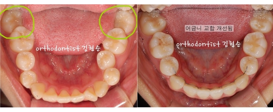 세라믹교정 은 세라믹치과 수술없이 돌출개선 관련 이미지 8