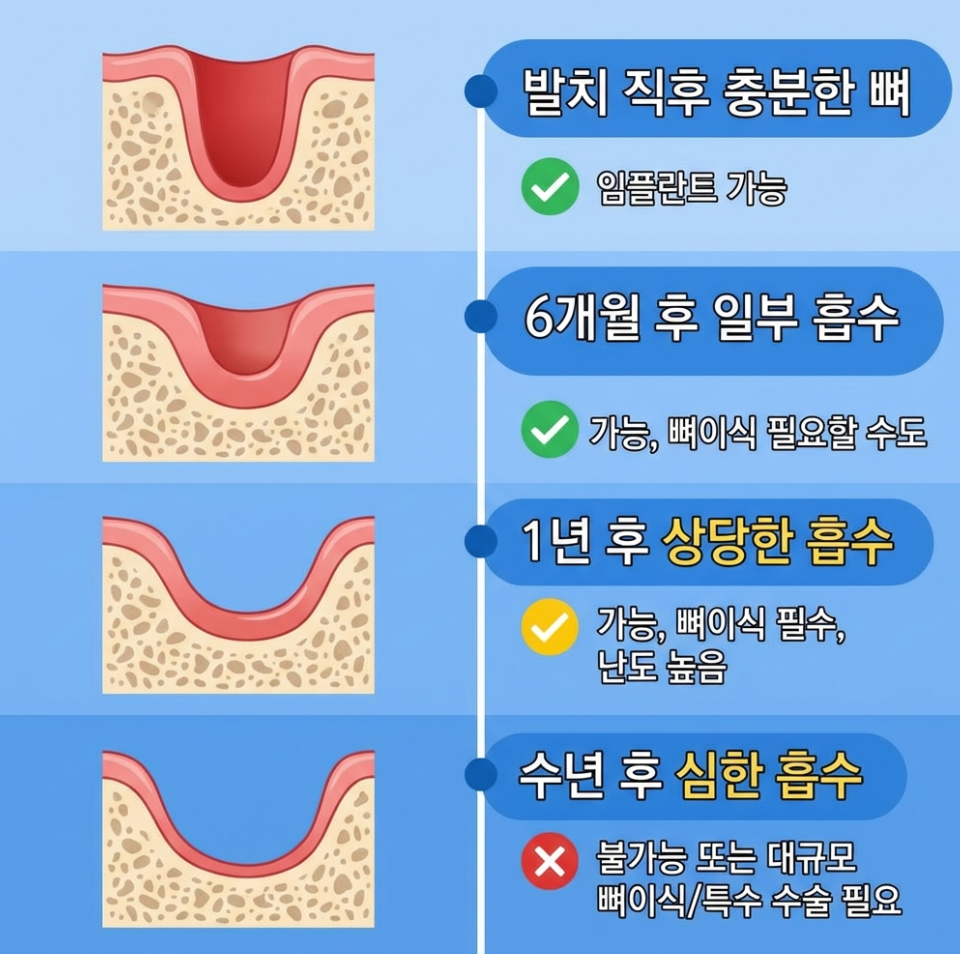 역삼동 치과, 임플란트 안 심고 살면 안 되나요? 관련 이미지 7