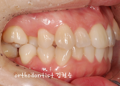 강남 덧니, 돌출 관련 이미지 8