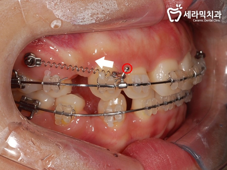 돌출입 교정으로 외모변화를 확인 관련 이미지 3