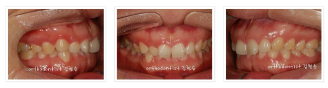 과개교합 ABP 교정 관련 이미지 7