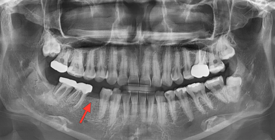 학동역 라미네이트 전후, 치아 모양과 색상 개선 사례 관련 이미지 2