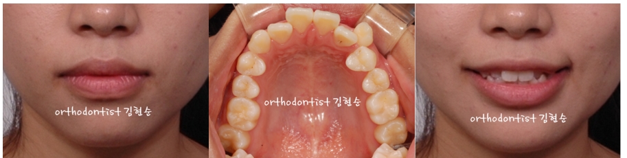 세라믹교정 은 세라믹치과 수술없이 돌출개선 관련 이미지 2