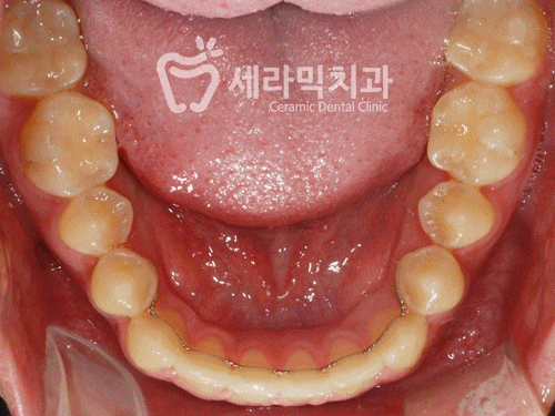 벌어진치아, 앞니벌어짐 치아교정전후 관련 이미지 5