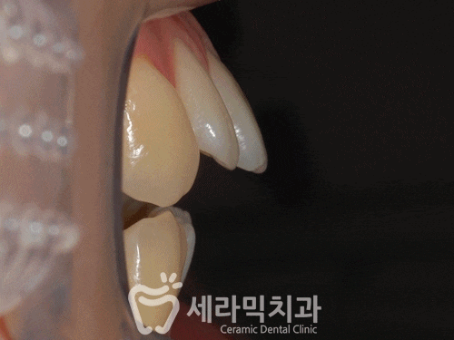 돌출입과 개방교합, 치아교정전후 자신감 UP! 치아건강 UP! 관련 이미지 7