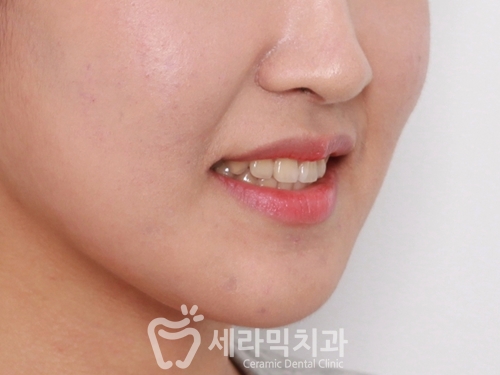 돌출입교정으로 갸름한 턱라인까지 되찾다! 돌출입 치아교정전후 관련 이미지 20