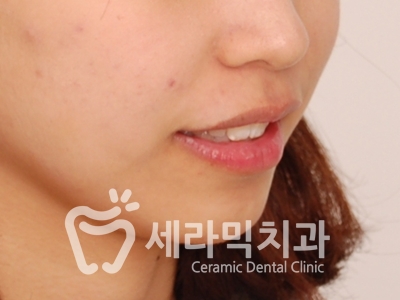 돌출입 잇몸노출 치아교정 전후 인상변화 사례 관련 이미지 15