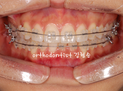 돌출 교정 (비발치 교정/비대칭) 관련 이미지 15