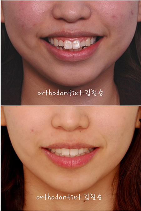 강남 돌출입 교정 관련 이미지 38