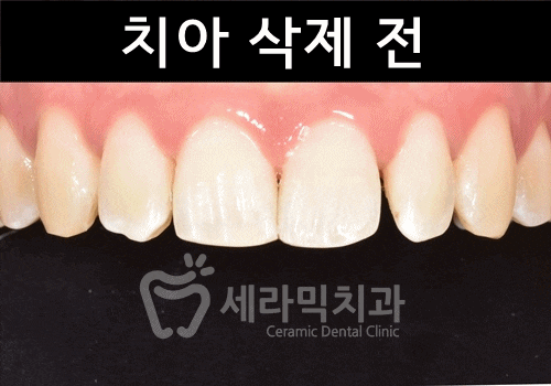 무삭제라미네이트 , 세라네이트가 궁금하다면? 관련 이미지 5