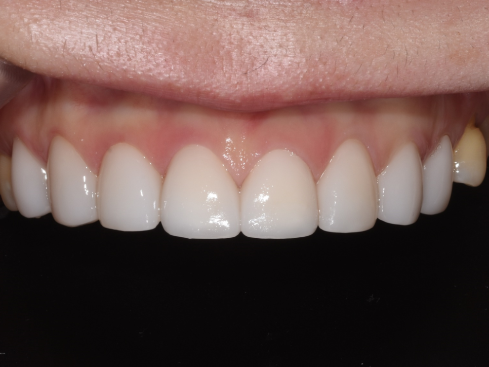 학동역 라미네이트 전후, 치아 모양과 색상 개선 사례 관련 이미지 11
