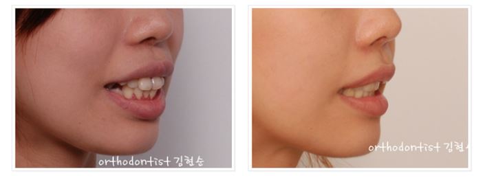 발치교정 부작용 옥니 해결법 관련 이미지 4