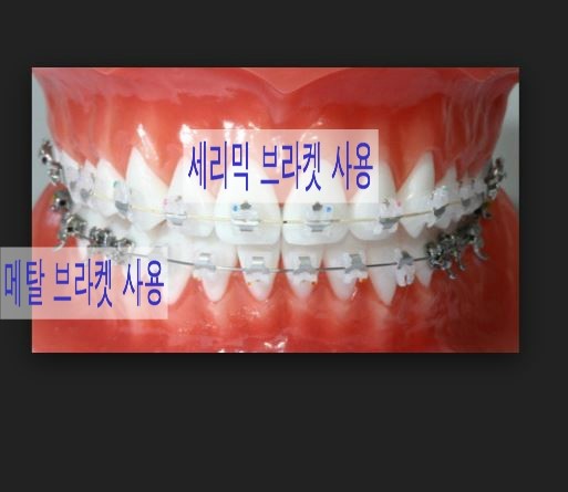 치아교정 부작용 세라믹교정 관련 이미지 5