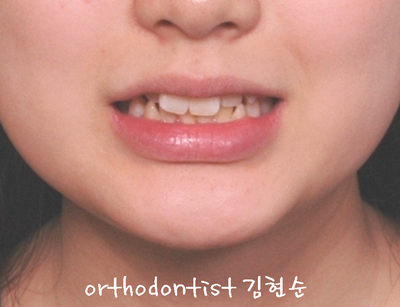 강남 돌출 (토끼 치아) 관련 이미지 3