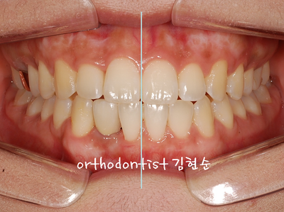 치열 교정 ( 벌어짐 ) 관련 이미지 20