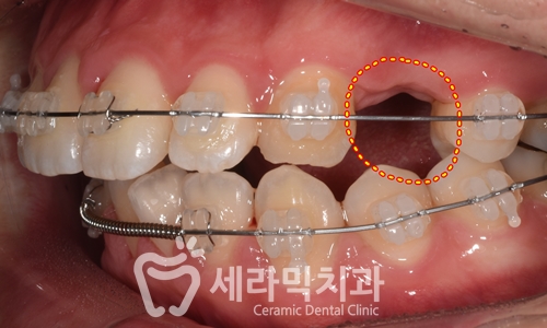 과개교합과 돌출입 개선으로 달라진 인상, 세라믹치과 치아교정전후! 관련 이미지 9