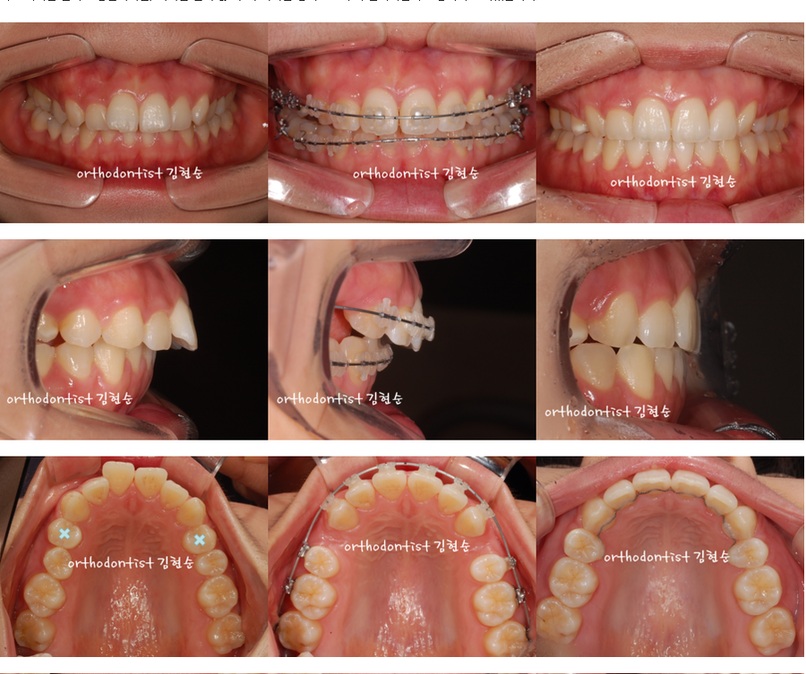 세라믹교정 세라믹치과-돌출입발치교정 2 관련 이미지 4
