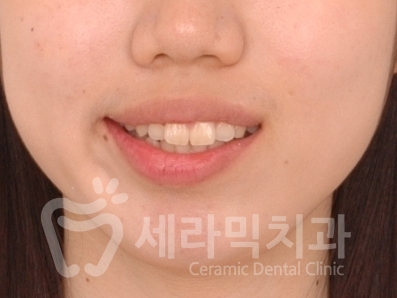 돌출입 치아교정 사례(학동역 치아교정 세라믹치과) 관련 이미지 3