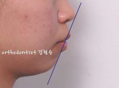 강남 돌출 관련 이미지 11